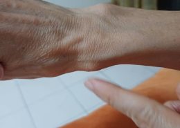 I am 63 y/o female. I got this bump on my wrist for more than 2 weeks and it is very painful, feels hard and bony… is it bone spur? do I need to do x-ray?