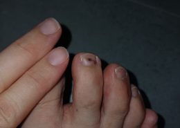 Why does my toe nail look like that? Isit trapped blood inside? Has been like that for few months and the only trigger I can think of is wearing new heels that were too tight..
