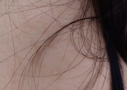 I have this dry patch on the back of my neck that itches occasionally, I have tried moisturizer and anti-fungal cream but the patch still doesnt go away but doesnt seem to be spreading as well.. how to tell if it is a fungal infection or eczema?