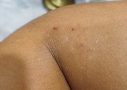 I noticed I get these bumps on my arm only when I’m stressed and only at that area. Why??