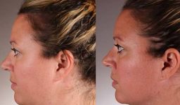 How Decades of Contact Lens Use Alters Eyelid Structure