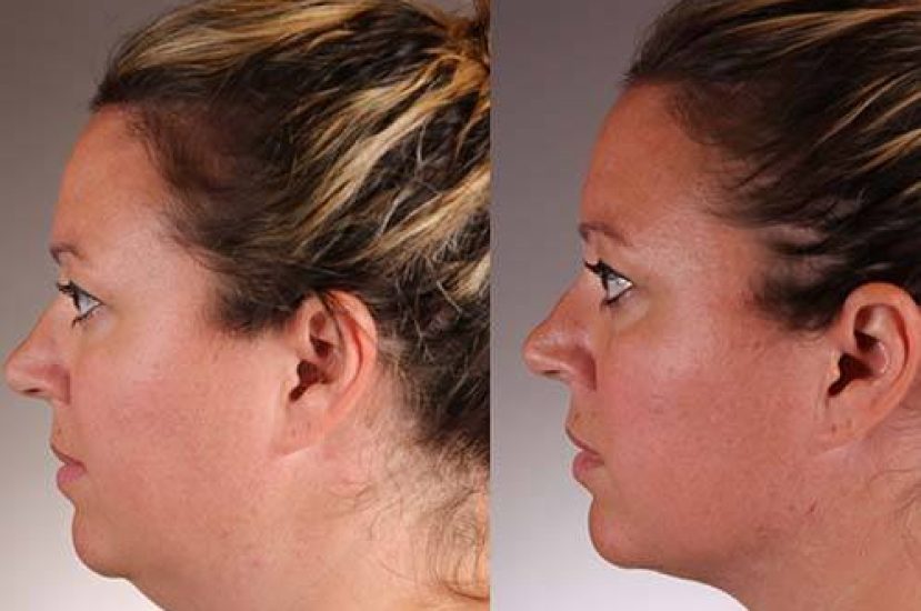 How Decades of Contact Lens Use Alters Eyelid Structure